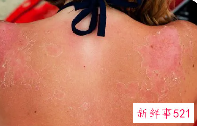 被晒伤了红红的怎么办