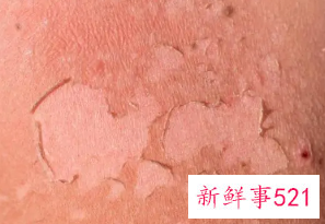 皮肤晒伤痒的厉害怎么办