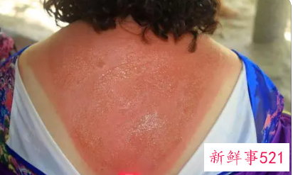 被晒伤了红红的怎么办