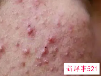 青春痘太多了怎么办