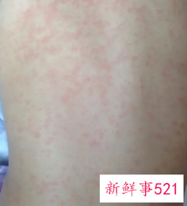 小孩出疹子怎么治