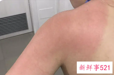被晒伤了红红的怎么办