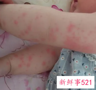 小孩出疹子怎么治