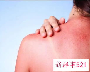 日光性皮炎没有阳光也发痒