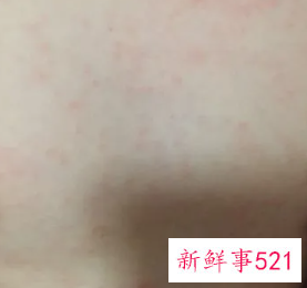 小孩出疹子怎么治