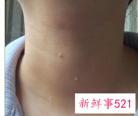 长了肿痛里面有脓的白色痘痘怎么办