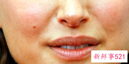 痘痘里面有白色的脓包