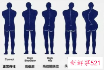 脊柱侧弯成危害我国儿童青少年健康的第三大疾病