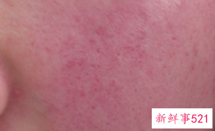 肌肤敏感该怎么办