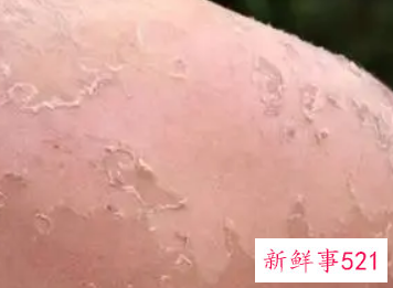 沙滩晒后如何修复