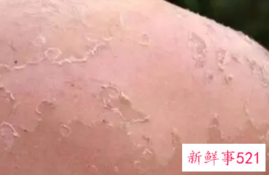 脸部晒伤了怎么快速修复