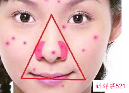 五大原因导致鼻梁上长痘痘