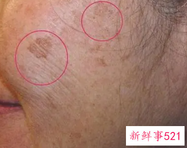 老人脸上长黑斑怎么办
