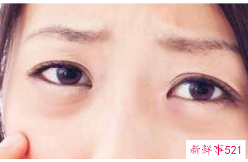 用什么去眼袋最快最有效