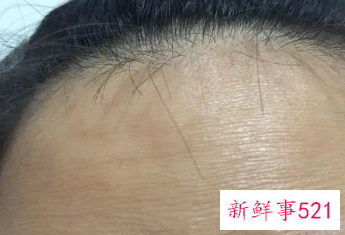 额头皱纹多怎么消除