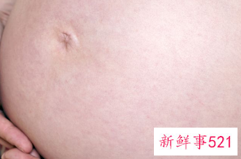 怎样除掉妊娠纹