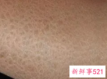 女人全身皮肤干燥是缺什么