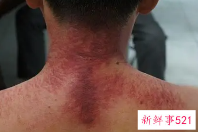 男人背部刮痧手法