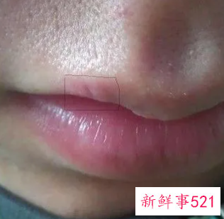 嘴上起泡怎么快速处理