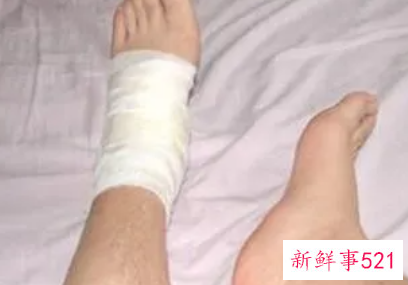 梦见自己脚底长了个大包