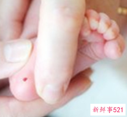 新生儿足底血多久出结果