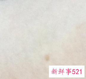 女性下面长了一个小肉粒是什么原因