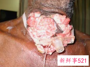 梦见身上挤出蛆虫