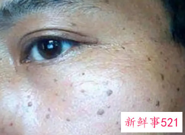 脸颊两边的斑越来越多