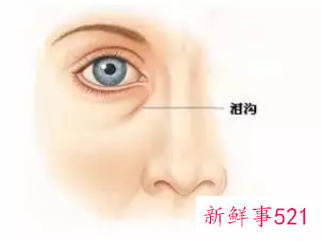 泪沟一旦形成很难消掉吗