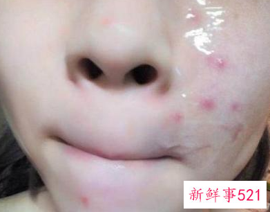 芦荟胶正确使用方法步骤