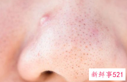 五大原因导致鼻梁上长痘痘
