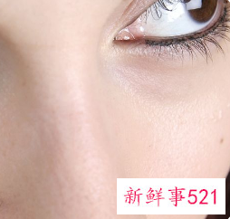 泪沟一旦形成很难消掉吗