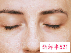 五个习惯导致雀斑