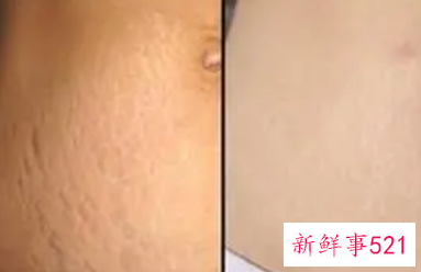 怎样除掉妊娠纹