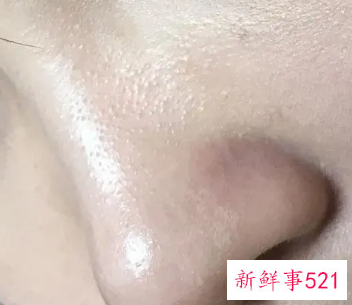 闭口粉刺是什么样子