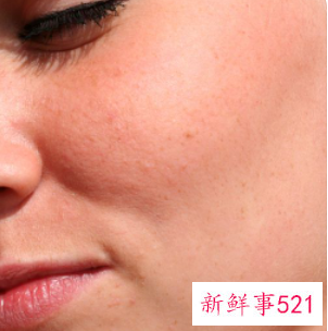 闭口粉刺是什么样子