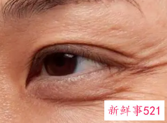 怎样消除眼部周围的皱纹