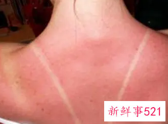 沙滩晒后如何修复