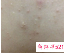 长了肿痛里面有脓的白色痘痘怎么办