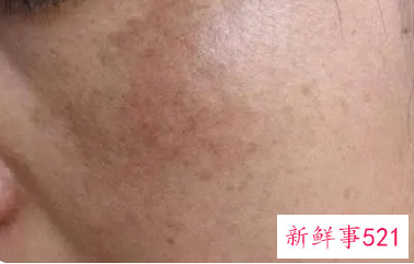 脸颊两边的斑越来越多