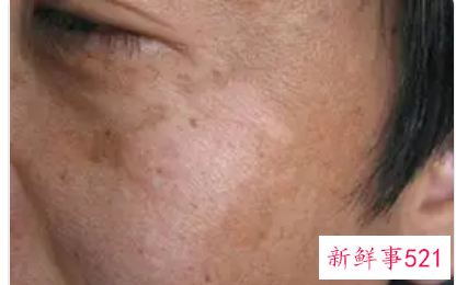 皮肤黑怎样变白