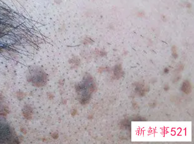 老人脸上长黑斑怎么办