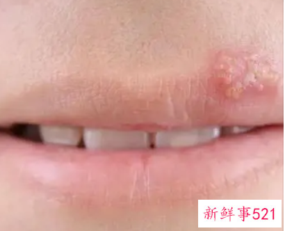 嘴上起泡怎么快速处理