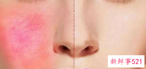 肌肤敏感该怎么办