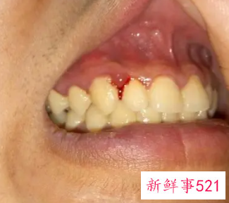 牙齿黄怎么办而且容易出血