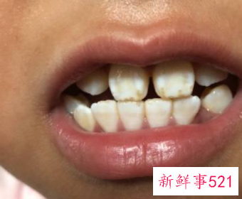 牙齿黄怎么办而且容易出血