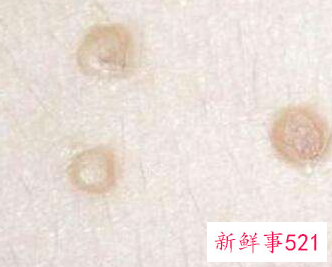 女性下面长了一个小肉粒是什么原因