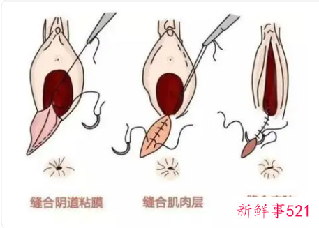 顺产撕裂伤口同房还痛怎么回事