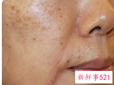 脸颊两边的斑越来越多