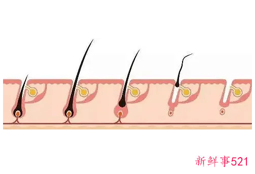 毛囊死了还能不能生发